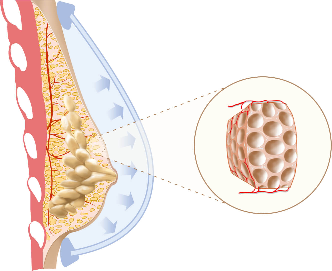 Aumento de Senos Natural con Transferencia de Grasa Corporal