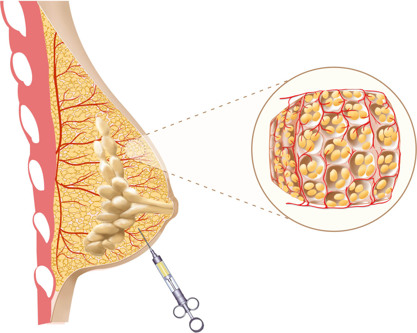 natural breast augmentation & enhancement with transfer 