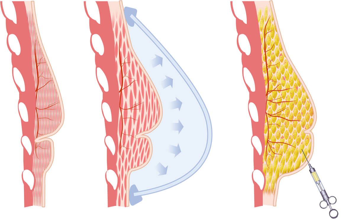 lumpectomy breast reconstruction fat injections