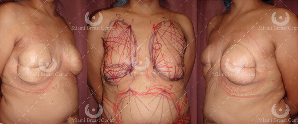 reconstruccion despues de mastectomia usando grasa corporal