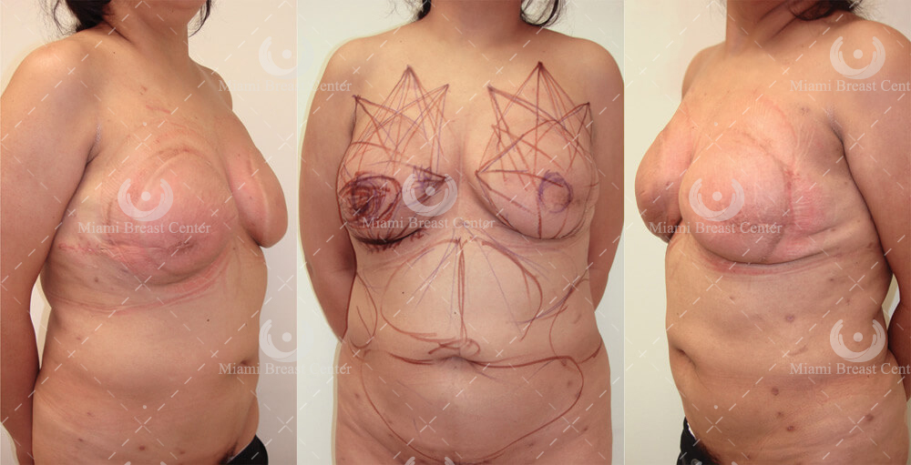 breast reconstruction after mastectomy