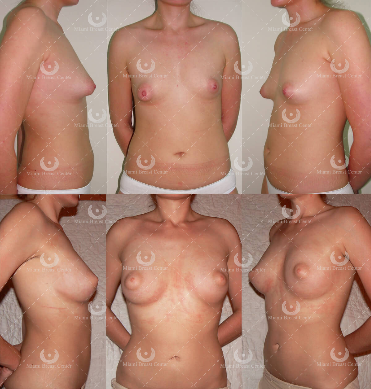 tubular breast correction before after