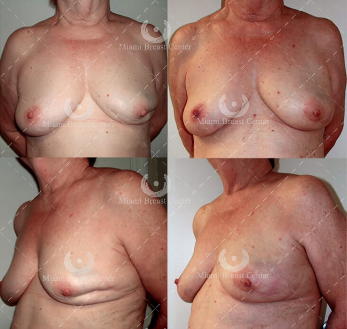 reconstrucción de mama antes y después foto Tumorectomía