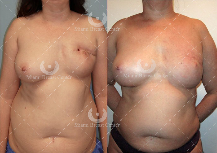 lumpectomy breast reconstruction before after photo