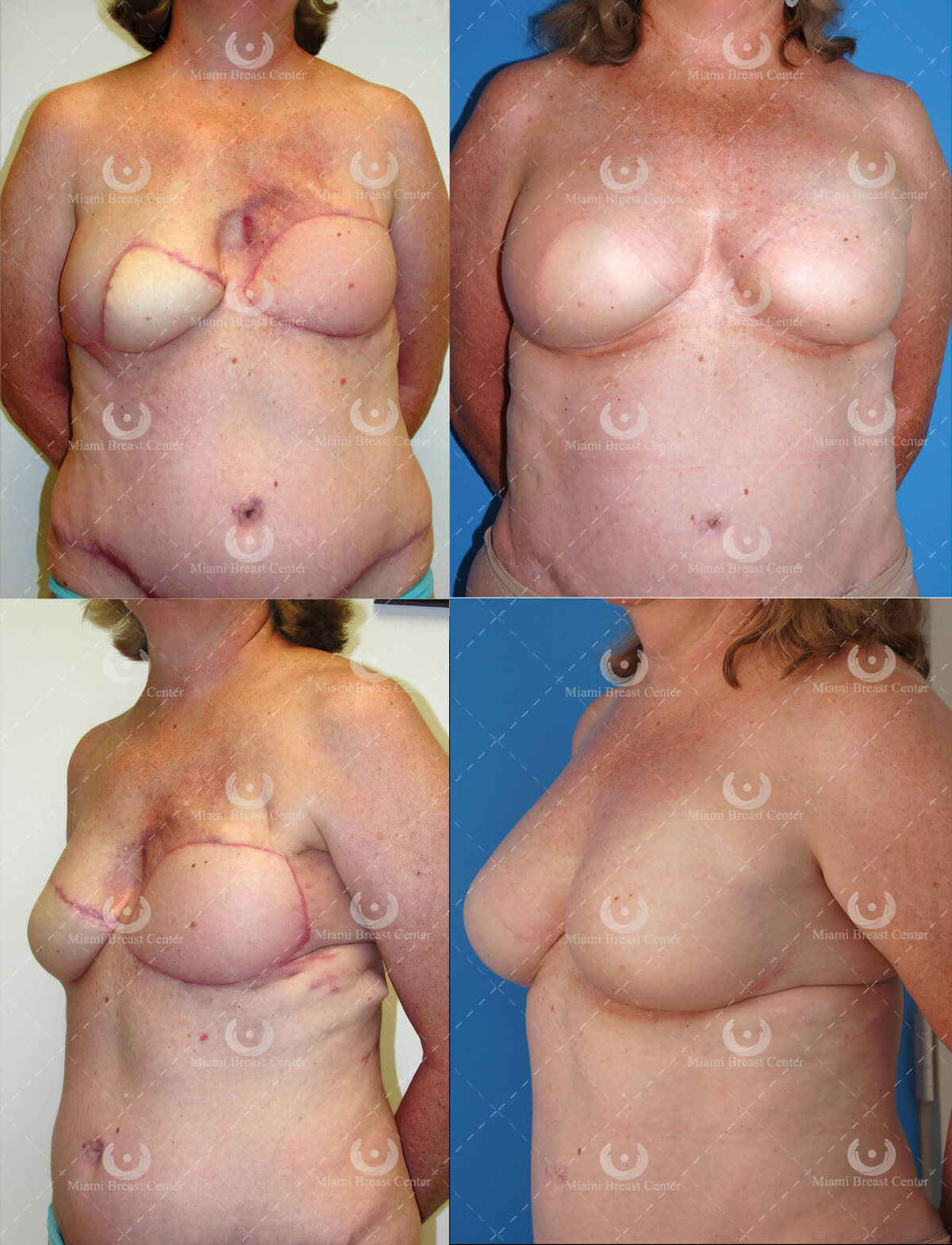 failed flap reconstruction with fat transfer