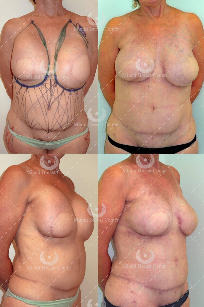 Failed Flap Breast Reconstruction