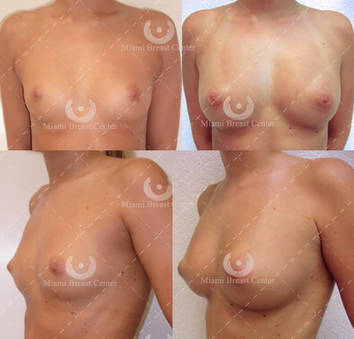 natural breast augmentation