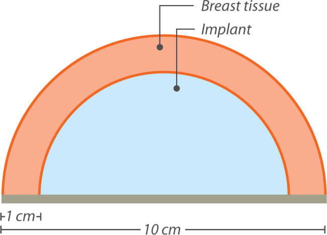 extraccion de implantes de seno