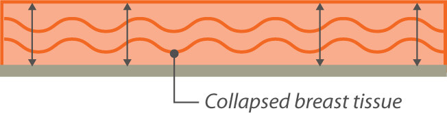 Problemas y Riesgos de los Implantes de Senos