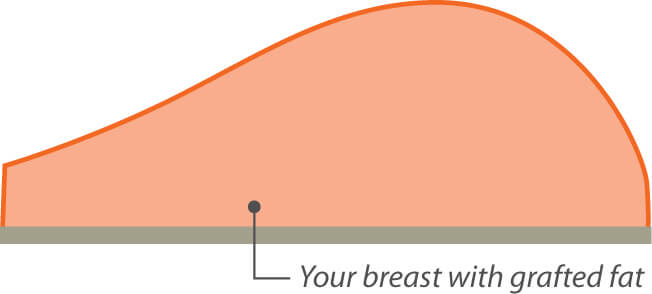 Transferencia de grasa corporal para reemplazar a los implantes