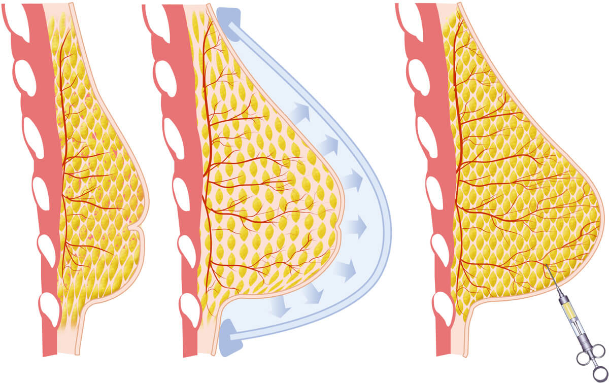 lumpectomy breast reconstruction with fat transfer