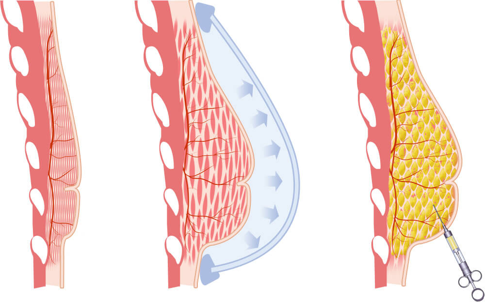 Breast reconstruction after mastectomy