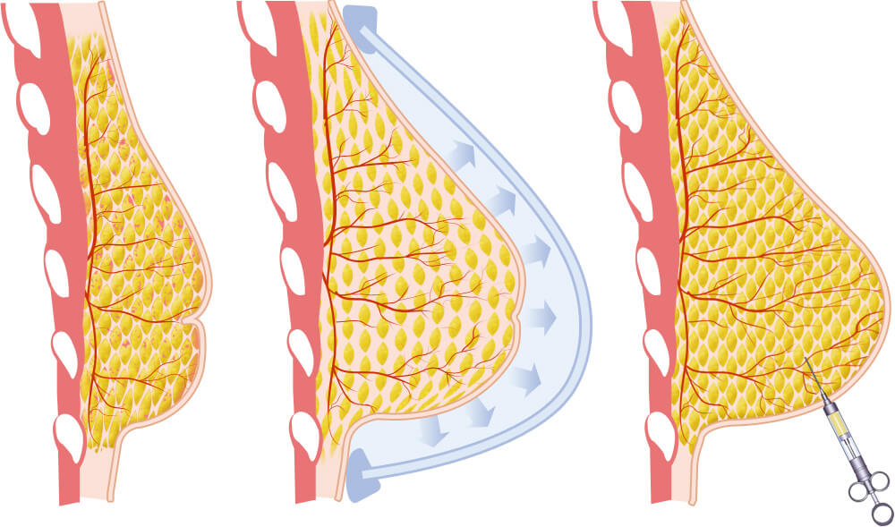 reconstrucción de senos después de la mastectomía con transferencia de grasa corporal