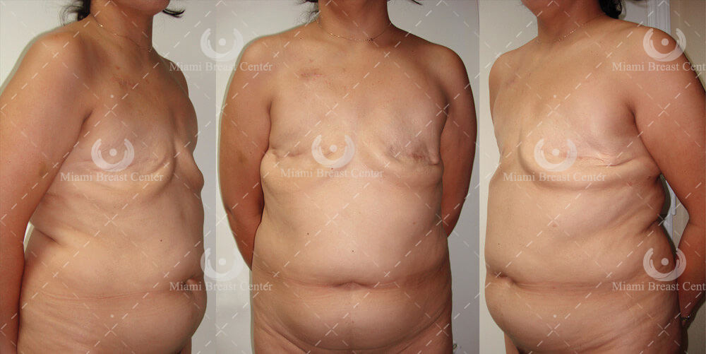 breast reconstruction surgery after mastectomy
