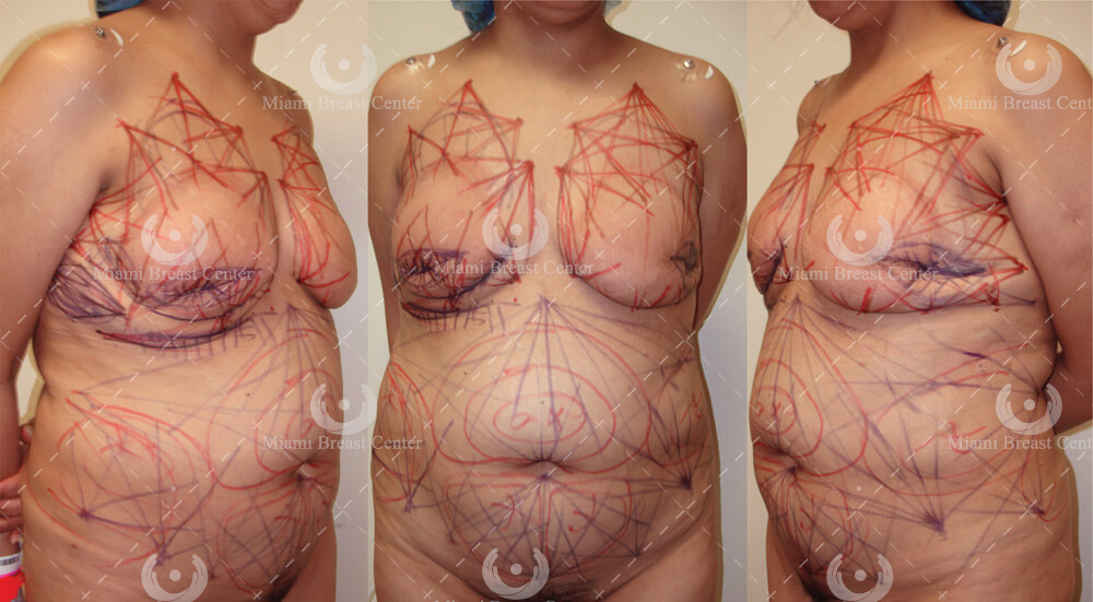 breast reconstruction surgery after mastectomy