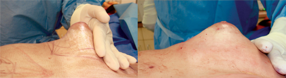 Tubular & Congenital Breast Deformity reconstruction, correction