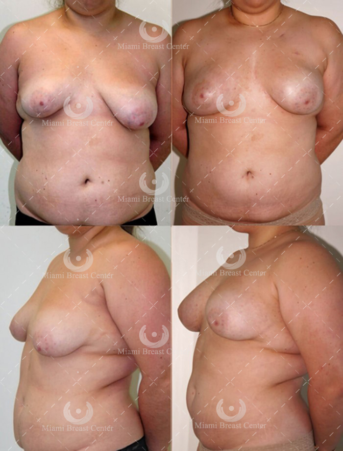 Asymmetry breast Deformity 
