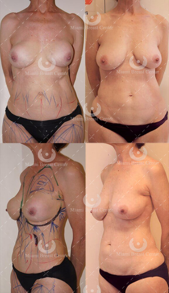 breast implant removal photo