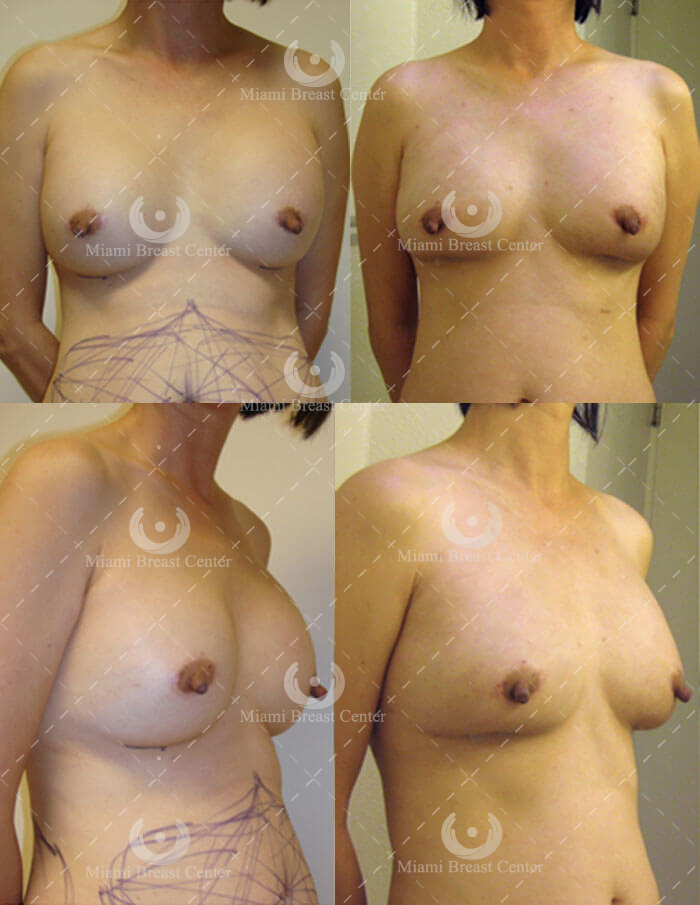 breast implant removal photo