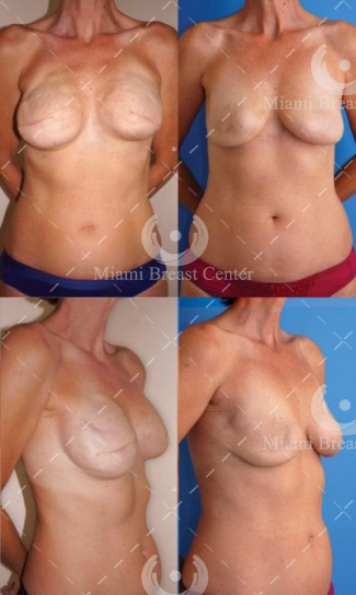 reconstrucción mamaria fracaso de implantes foto antes después