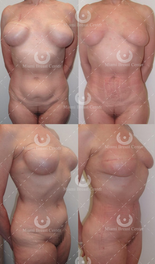 reconstrucción mamaria fallo de implantes foto antes después