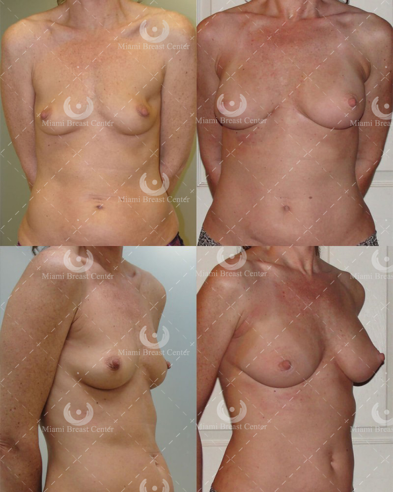 breast augmentation with fat transfer