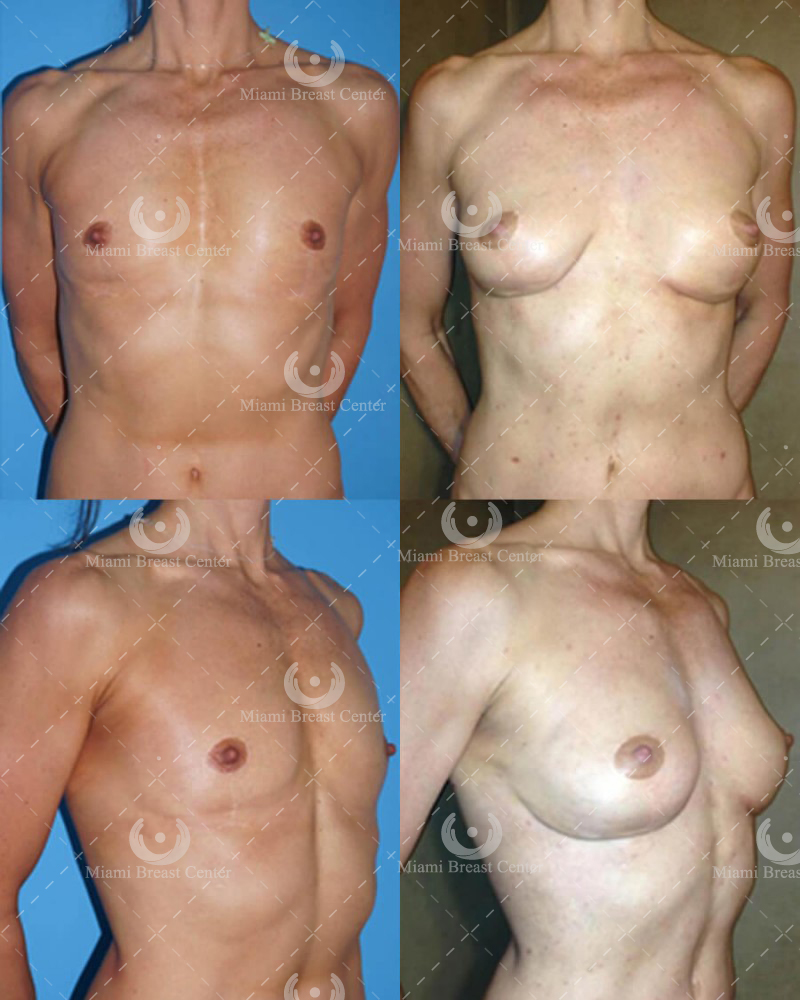 Breast augmentation with fat transfer