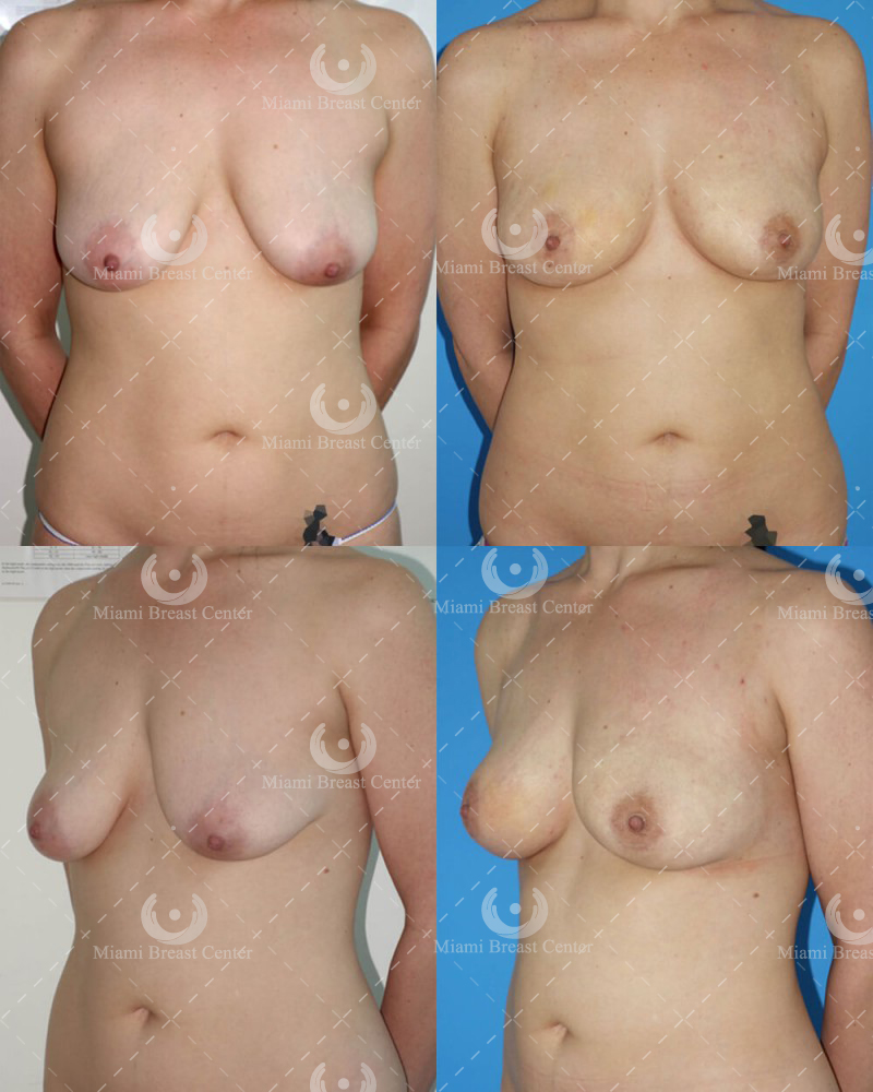 breast augmentation photos
