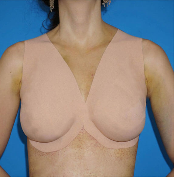 Natural Breast Lift Without Incisions or Implants - Miami Breast