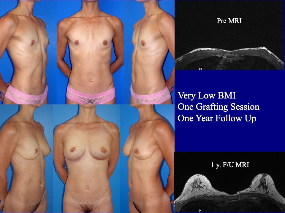 Breast Augmentation Before and After 1