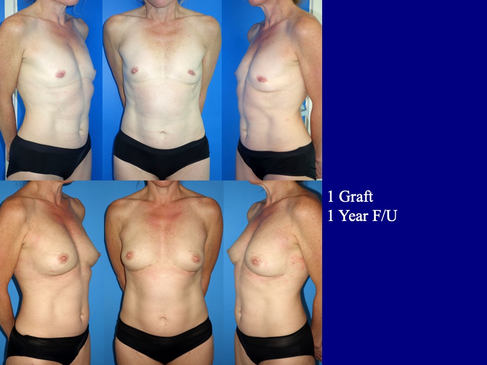 Breast Augmentation Before and After 10