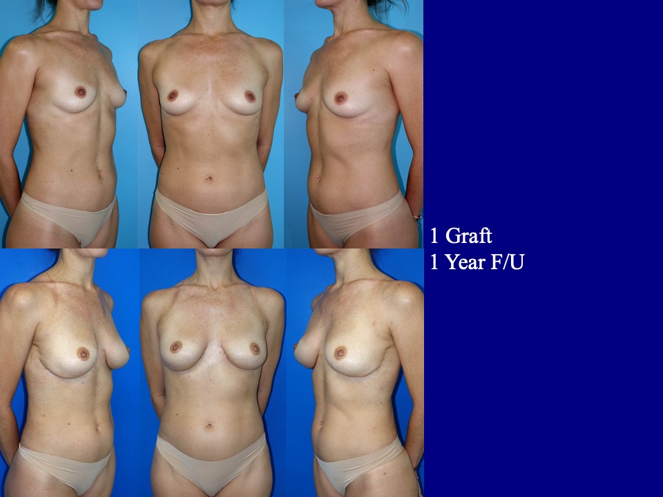 Breast Augmentation Before and After 11