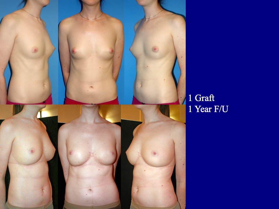 Breast Augmentation Before and After 12