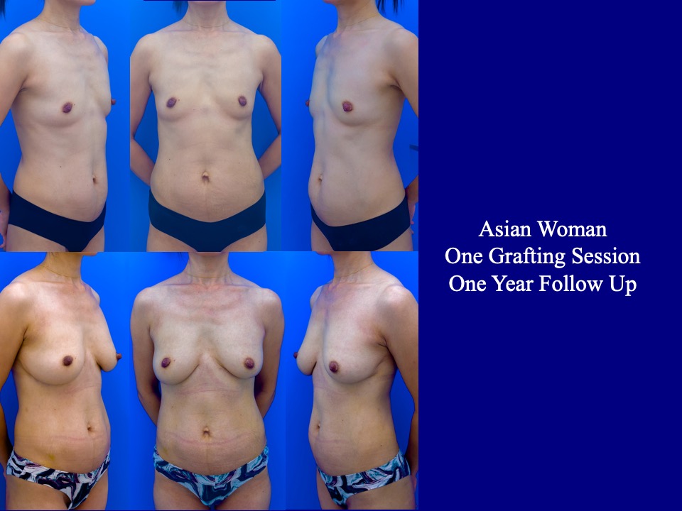 Breast Augmentation Before and After 13