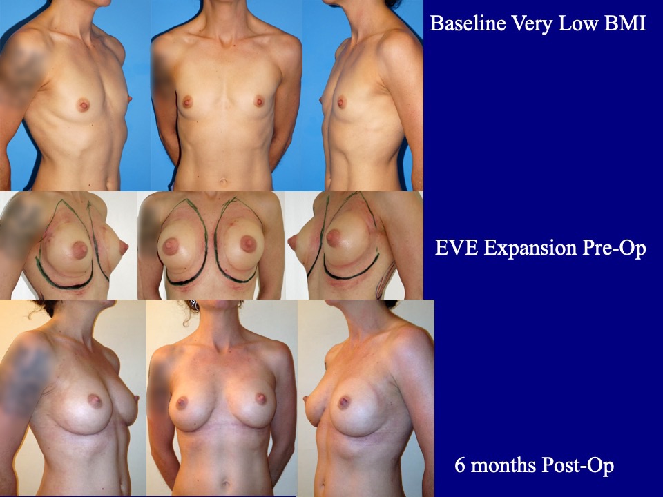 Breast Augmentation Before and After 15