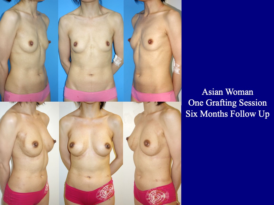 Breast Augmentation Before and After 16