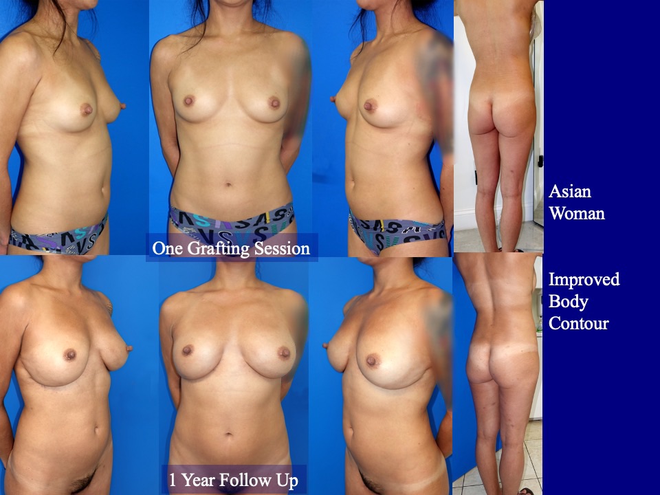 Breast Augmentation Before and After 17