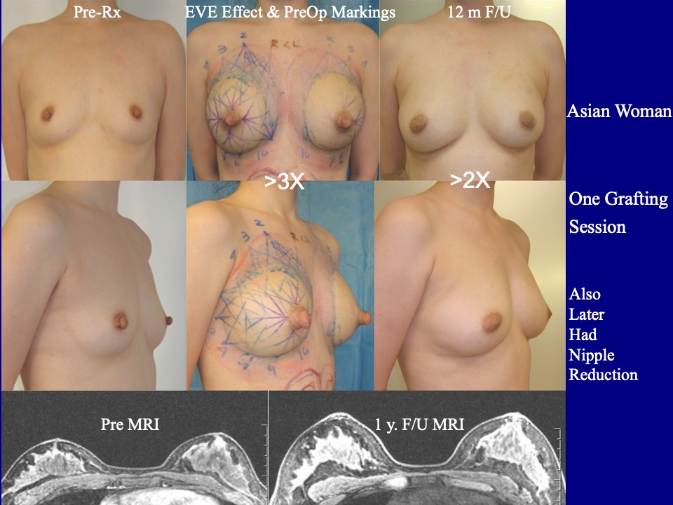 Breast Augmentation Before and After 18