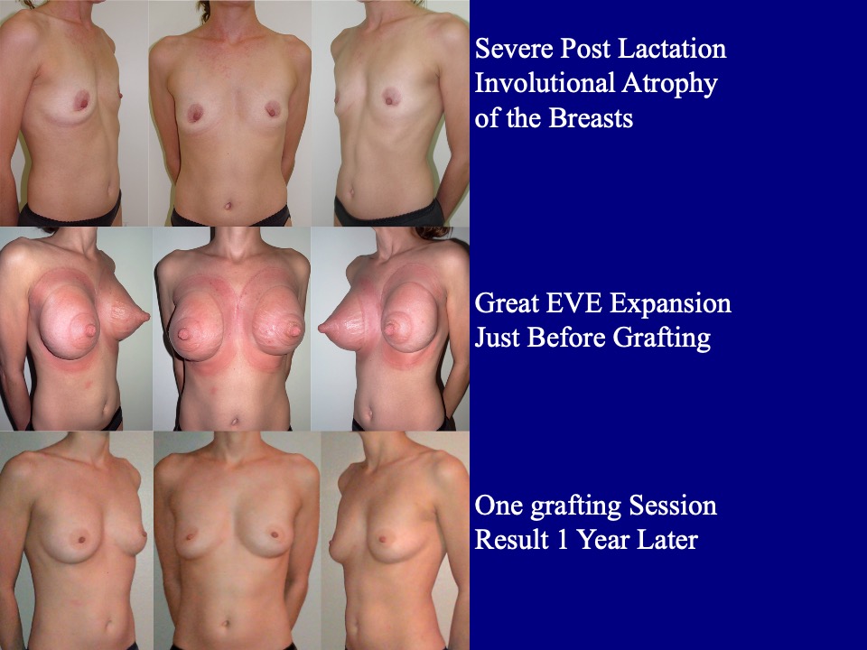 Breast Augmentation Before and After 19