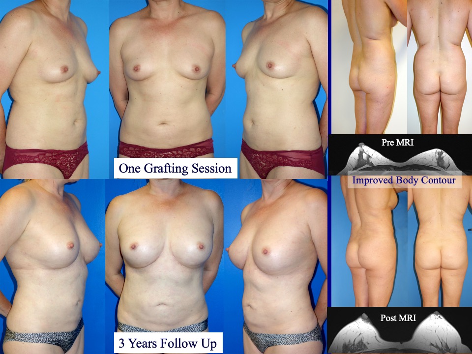 Breast Augmentation Before and After 2