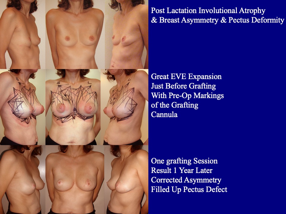 Breast Augmentation Before and After 20