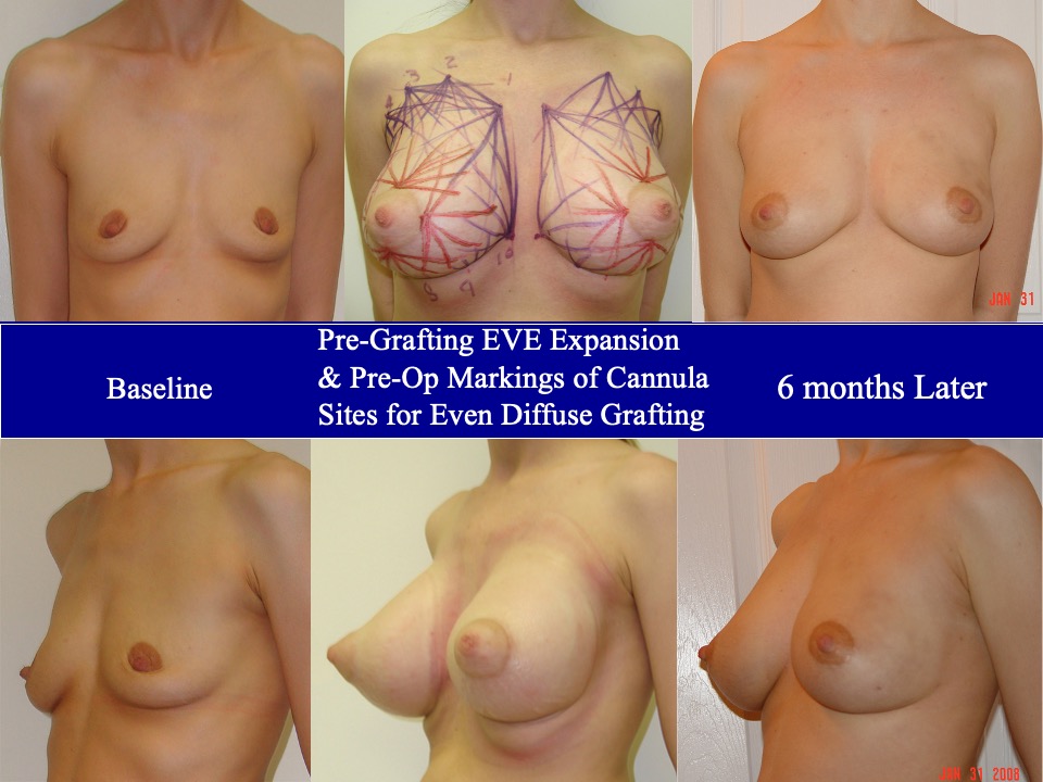 Breast Augmentation Before and After 21