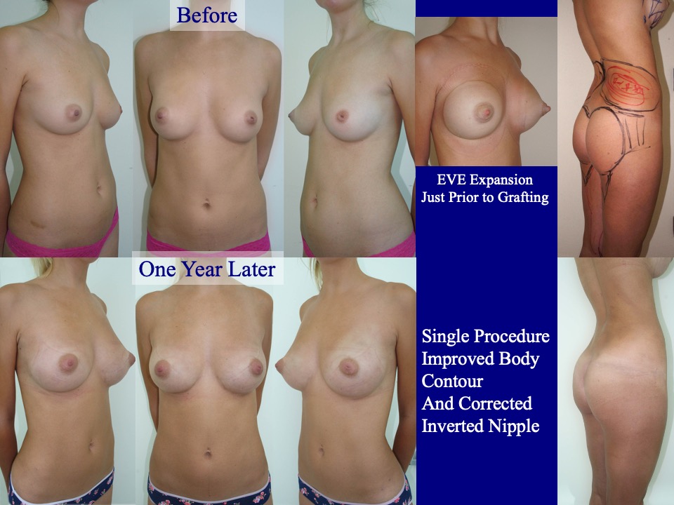 Breast Augmentation Before and After 22