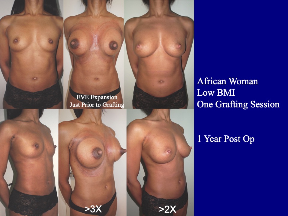 Breast Augmentation Before and After 23