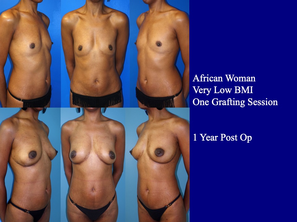 Breast Augmentation Before and After 24