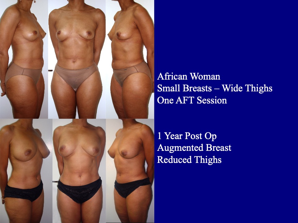 Breast Augmentation Before and After 25