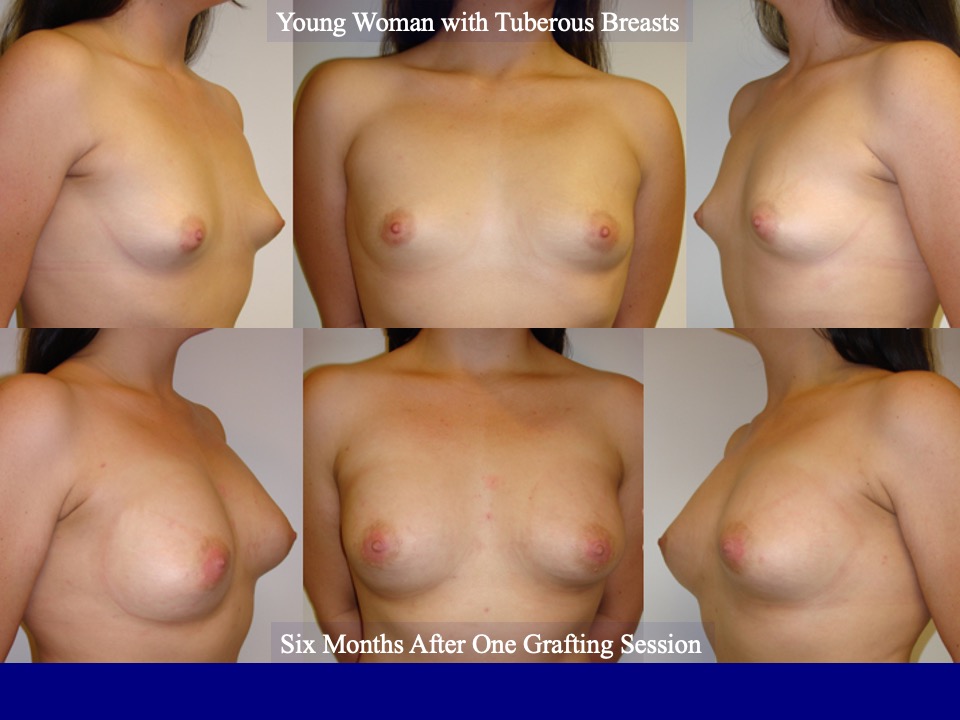 Breast Augmentation Before and After 26