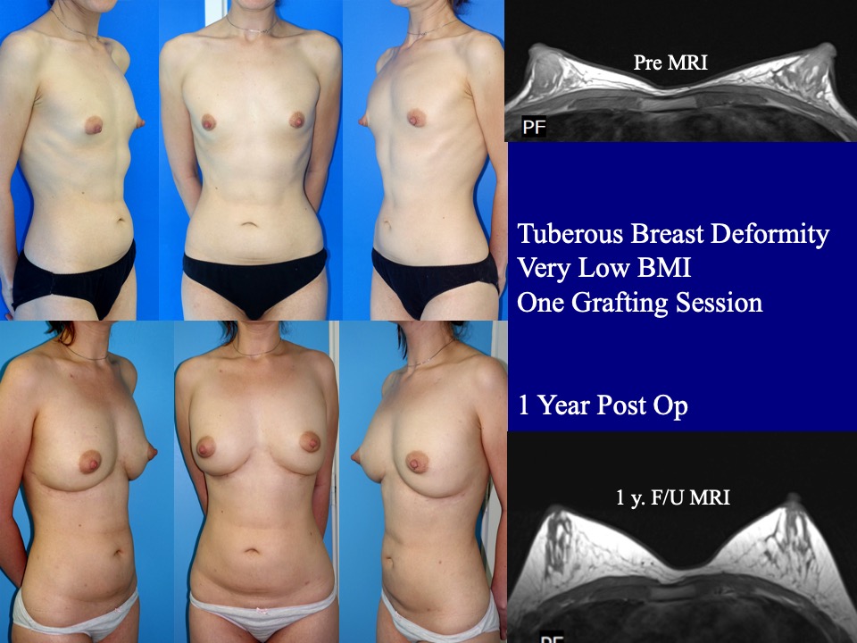 Breast Augmentation Before and After 27