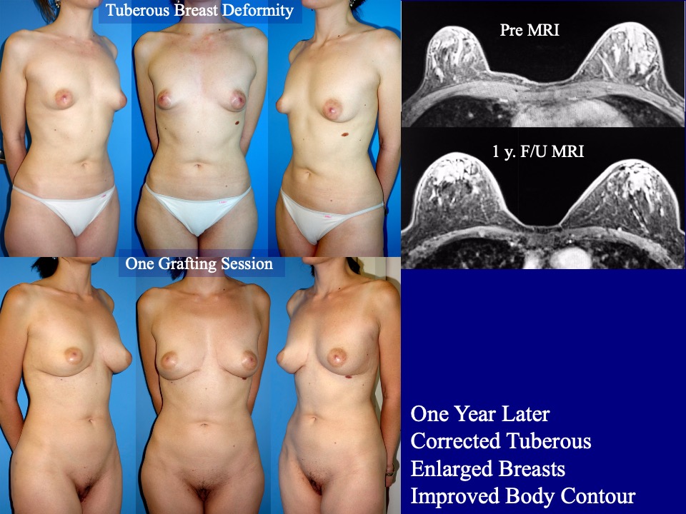 Breast Augmentation Before and After 28