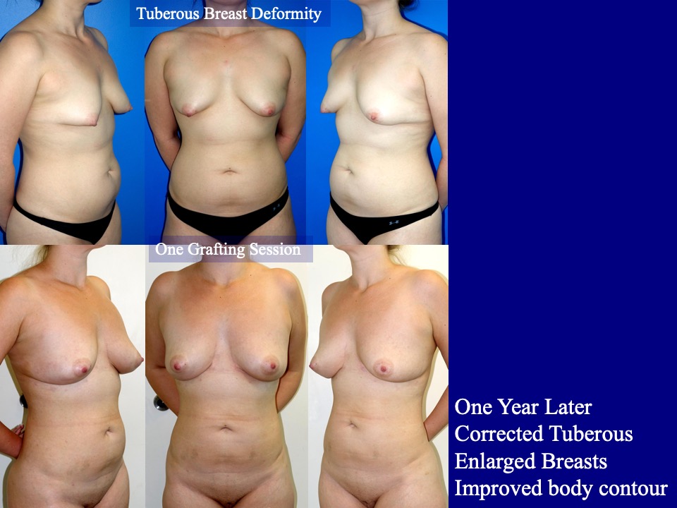 Breast Augmentation Before and After 29